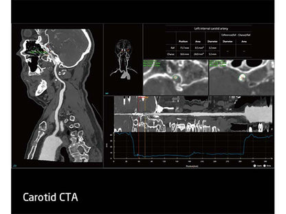 Neusoft NeuViz ACE 64e CT