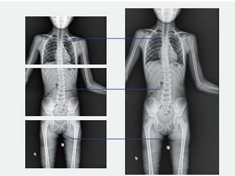 Perlove PLD7100 Ceiling Suspended Digital Radiography (1)