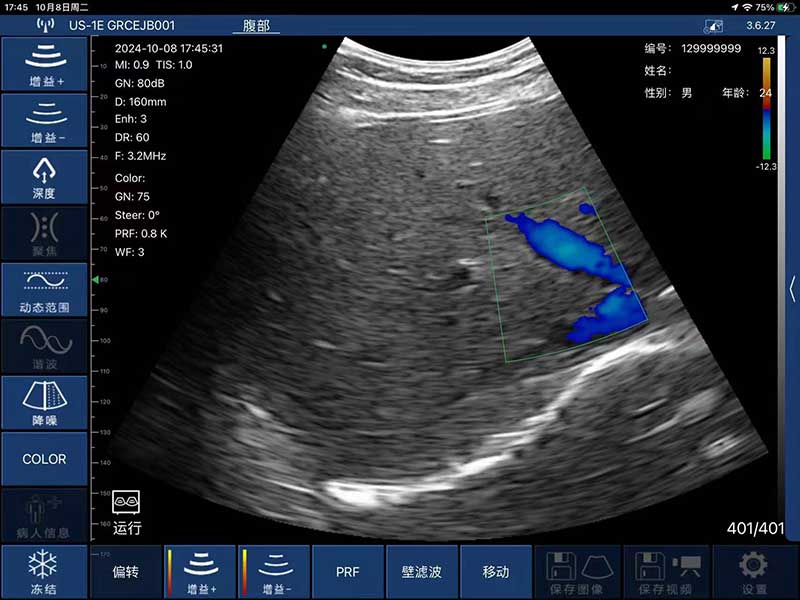 Global Healthcare Medical interchangeable-probe palm Doppler ultrasound scanner with magnetic probe connection for point-of-care imaging