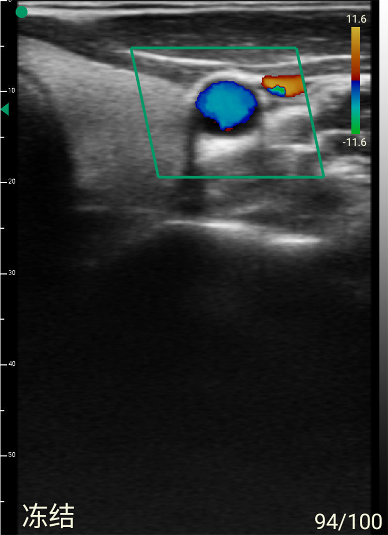 Global Healthcare Medical 2-in-1 palm doppler ultrasound scanner with dual-frequency linear array for point-of-care imaging
