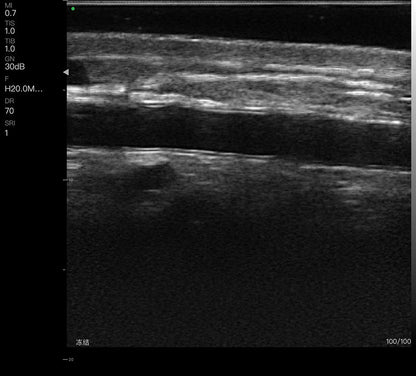 Global Healthcare Medical 2-in-1 palm doppler ultrasound scanner with dual-frequency linear array for point-of-care imaging