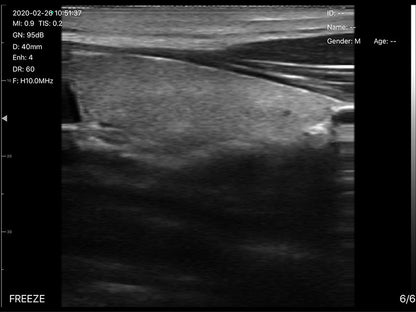 Global Healthcare Medical 2-in-1 palm doppler ultrasound scanner with convex and linear probes for point-of-care imaging