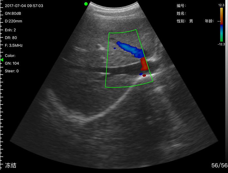 Global Healthcare Medical 2-in-1 palm doppler ultrasound scanner with convex and linear probes for point-of-care imaging