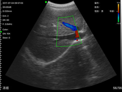 Global Healthcare Medical 2-in-1 palm doppler ultrasound scanner with convex and linear probes for point-of-care imaging