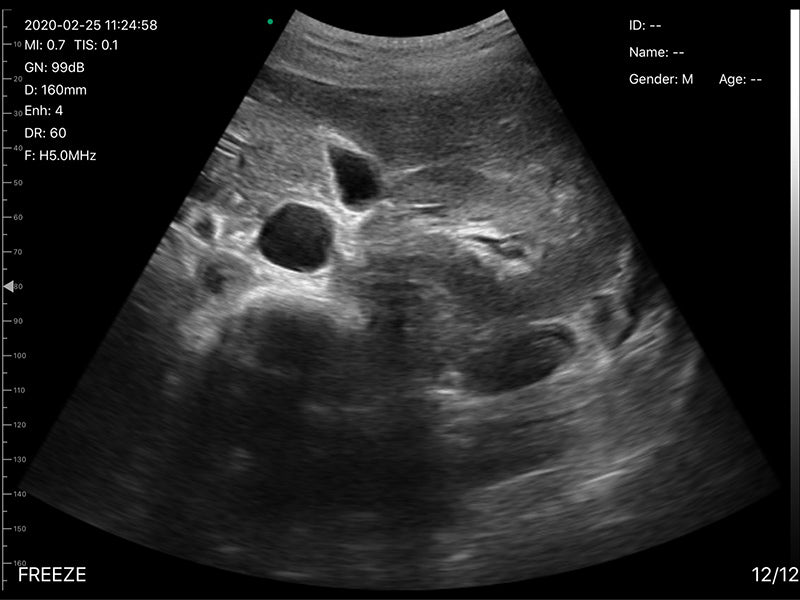 Global Healthcare Medical 2-in-1 palm doppler ultrasound scanner with convex and linear probes for point-of-care imaging