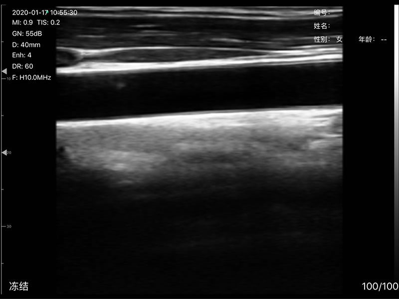 Global Healthcare Medical 2-in-1 palm doppler ultrasound scanner with phased array and linear probes for point-of-care imaging