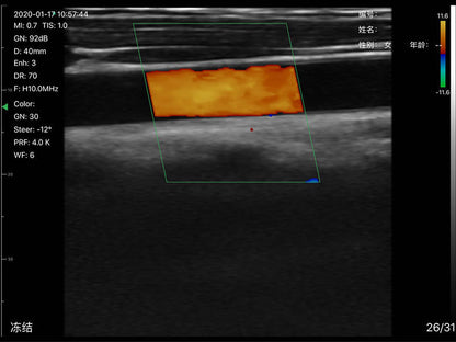 Global Healthcare Medical 2-in-1 palm doppler ultrasound scanner with phased array and linear probes for point-of-care imaging