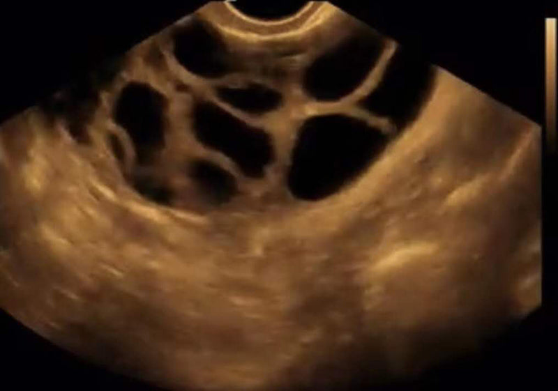 Global Healthcare Medical wireless handheld transvaginal ultrasound scanner with 128-element probe for pelvic and gynecological imaging