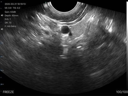 Global Healthcare Medical wireless handheld transvaginal ultrasound scanner with 128-element probe for pelvic and gynecological imaging