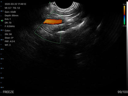 Global Healthcare Medical wireless handheld transvaginal ultrasound scanner with 128-element probe for pelvic and gynecological imaging
