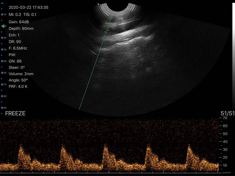 Global Healthcare Medical wireless handheld transvaginal ultrasound scanner with 128-element probe for pelvic and gynecological imaging