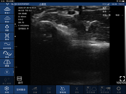 Global Healthcare Medical finger-sleeve probe handheld ultrasound scanner with 192-element linear array for hands-free imaging