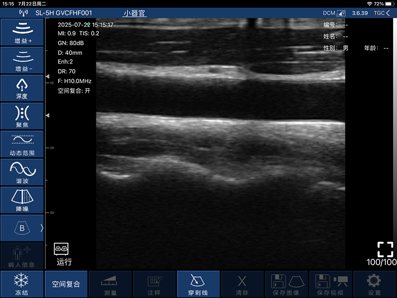 Global Healthcare Medical finger-sleeve probe handheld ultrasound scanner with 192-element linear array for hands-free imaging