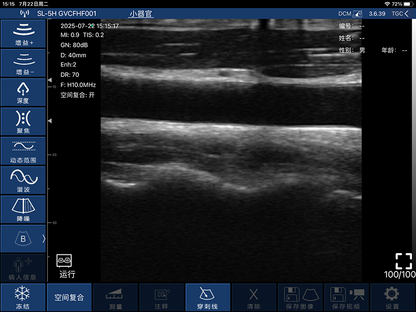Global Healthcare Medical finger-sleeve probe handheld ultrasound scanner with 192-element linear array for hands-free imaging