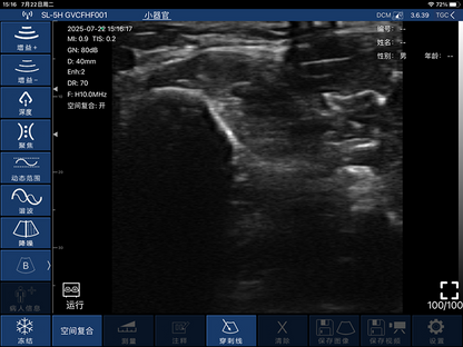 Global Healthcare Medical finger-sleeve probe handheld ultrasound scanner with 192-element linear array for hands-free imaging
