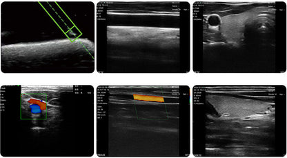 Global Healthcare Medical palm-sized wireless linear color Doppler ultrasound scanner with magnetic navigation for precise needle visualization