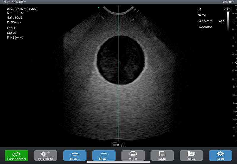 Global Healthcare Medical wireless 4D bladder scanner with single probe design for rapid bladder volume measurement