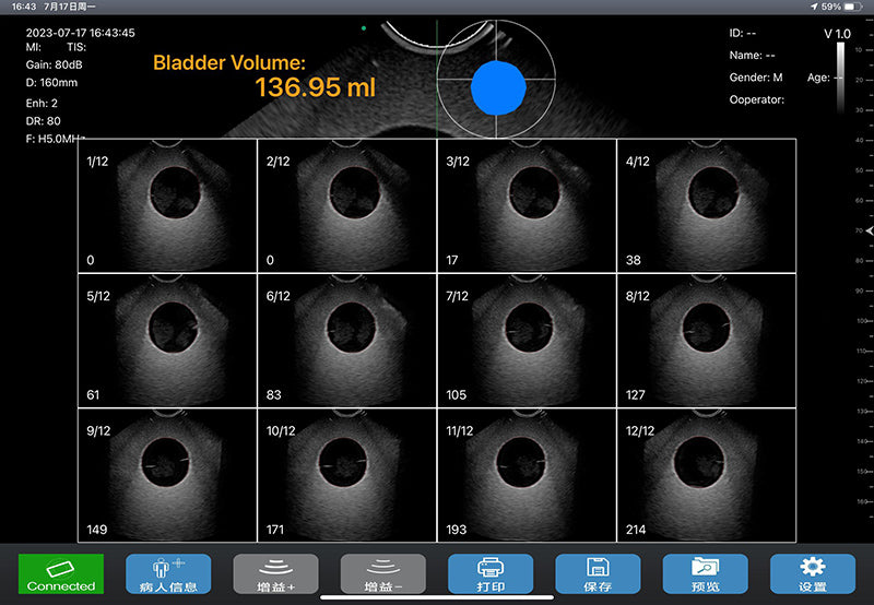 Global Healthcare Medical wireless 4D bladder scanner with single probe design for rapid bladder volume measurement