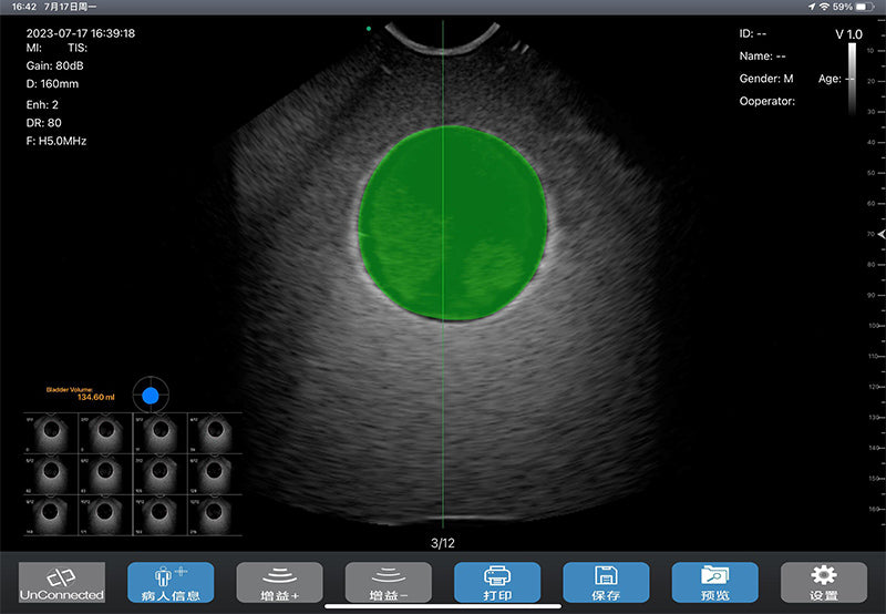 Global Healthcare Medical wireless 4D bladder scanner with single probe design for rapid bladder volume measurement