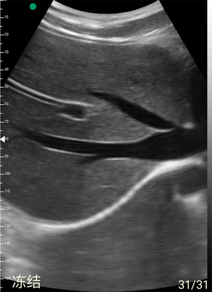 Global Healthcare Medical wireless handheld convex array ultrasound system for abdominal and point-of-care imaging