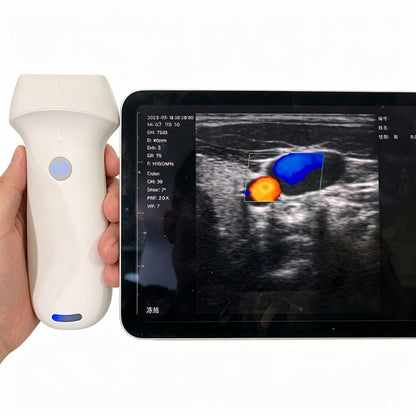 Global Healthcare Medical high-frequency wireless linear ultrasound system with replaceable battery for musculoskeletal and vascular point-of-care imaging