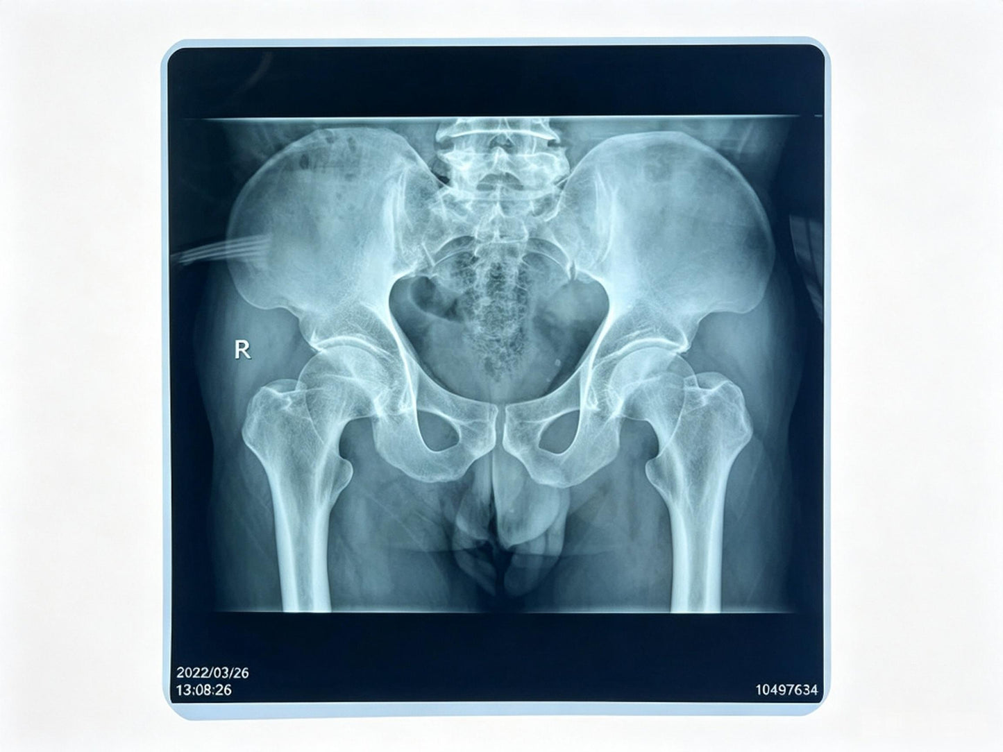 X-ray Film Medical Dry Film Thermal – High-Quality Direct Thermal Imaging Film for Diagnostic Radiology